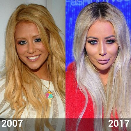 Aubrey O'Day lips filler and plastic surgery.