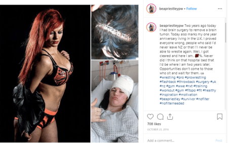 Bea Priestley was diagnosed with a brain tumor when she was 14 and underwent surgery at 18.