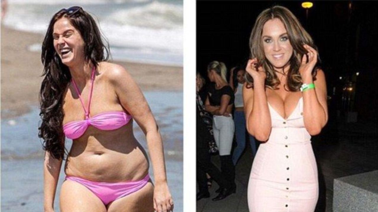 Vicky Pattison before and after plastic surgery.