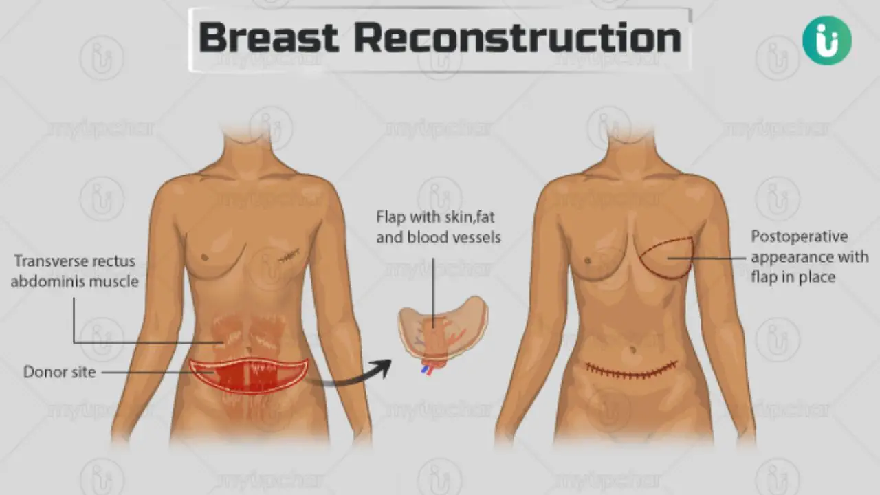 Breast reconstruction restores a breast to a near-normal form and appearance after a mastectomy. celebsindepth.com