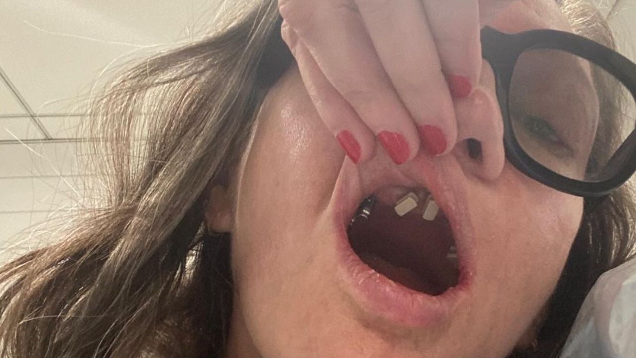Jenna Lyons had her new teeth installed in 2022 with 13 oral surgery. celebsindepth.com