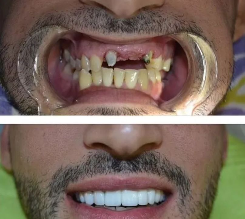 Sam Asghari's bafore and after teeth. celebsindepth.com