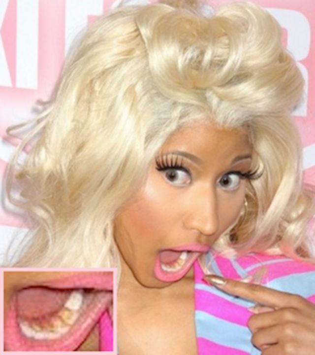 You can see Nicki Minaj's yellow teeth. celebsindepth.com