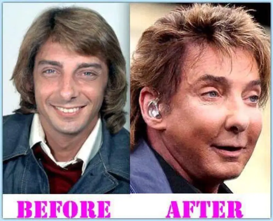 Barry Manilow has changed a lot since undergoing plastic surgery. celebsindepth.com