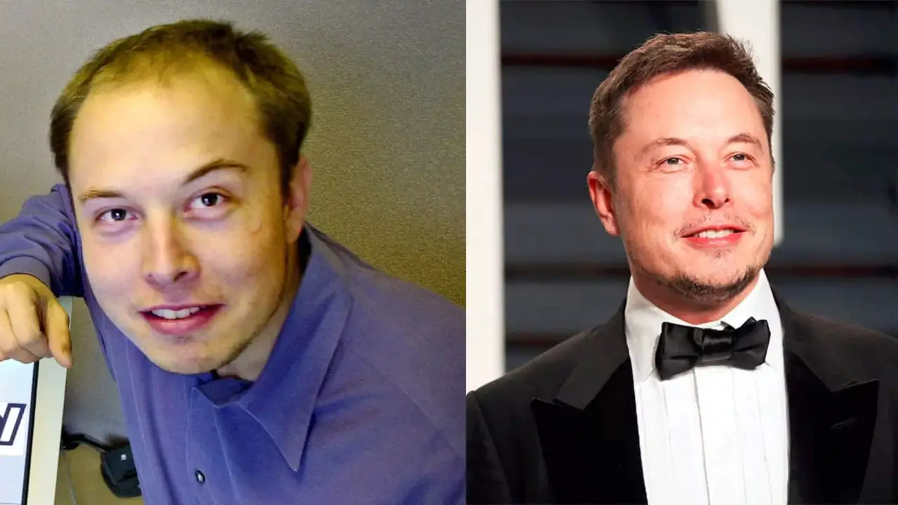 Elon Musk’s Plastic Surgery: Before and After Changes Analyzed!
