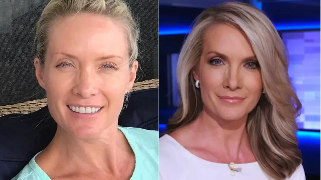 Dana Perino's Plastic Surgery Facelift, Botox, Fillers, Blepharoplasty