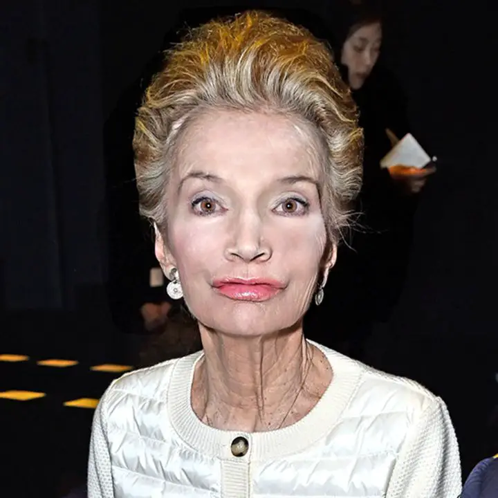 Clear difference in Lee Radziwill face and neck due to botox and facelifts. celebsindepth.com